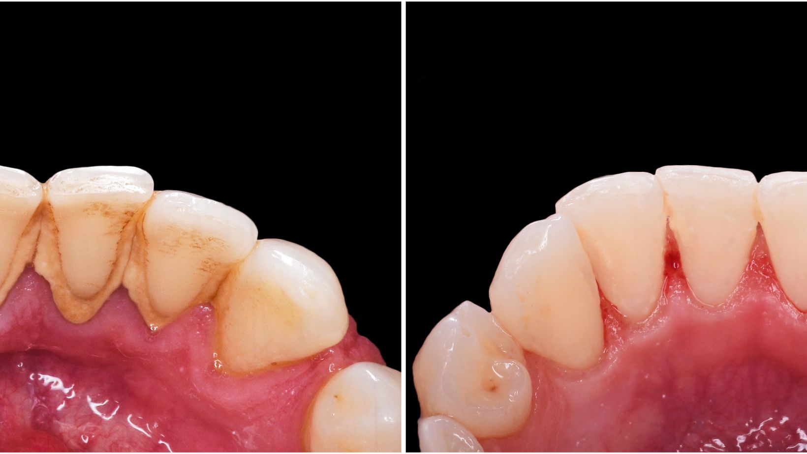 Before and After Dental Scaling
