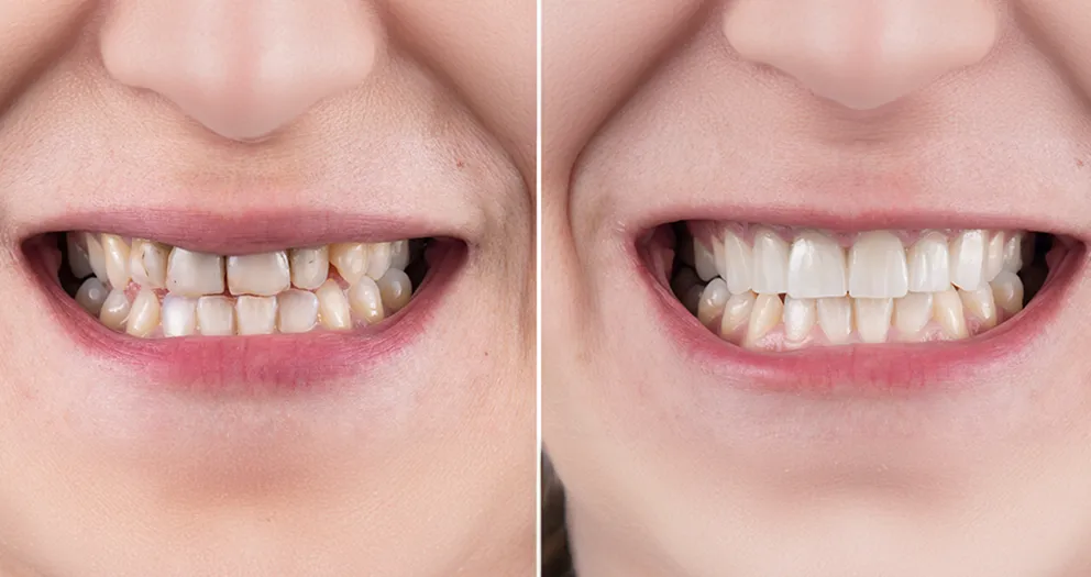 Before and After Dental Veneers