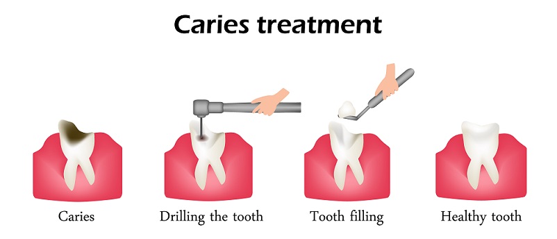 Caries Treatment and Dental Fillings
