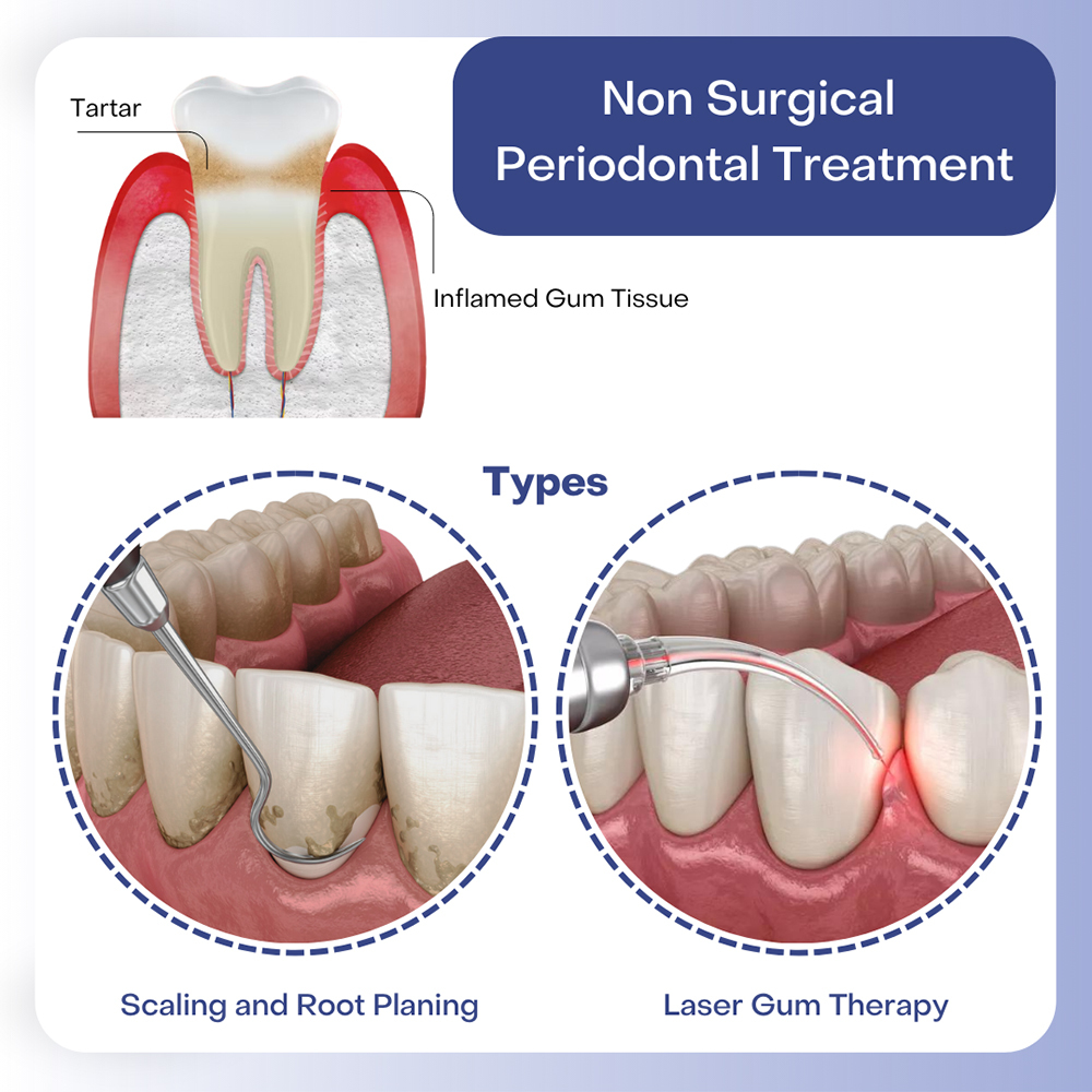 Deep Gum Cleaning
