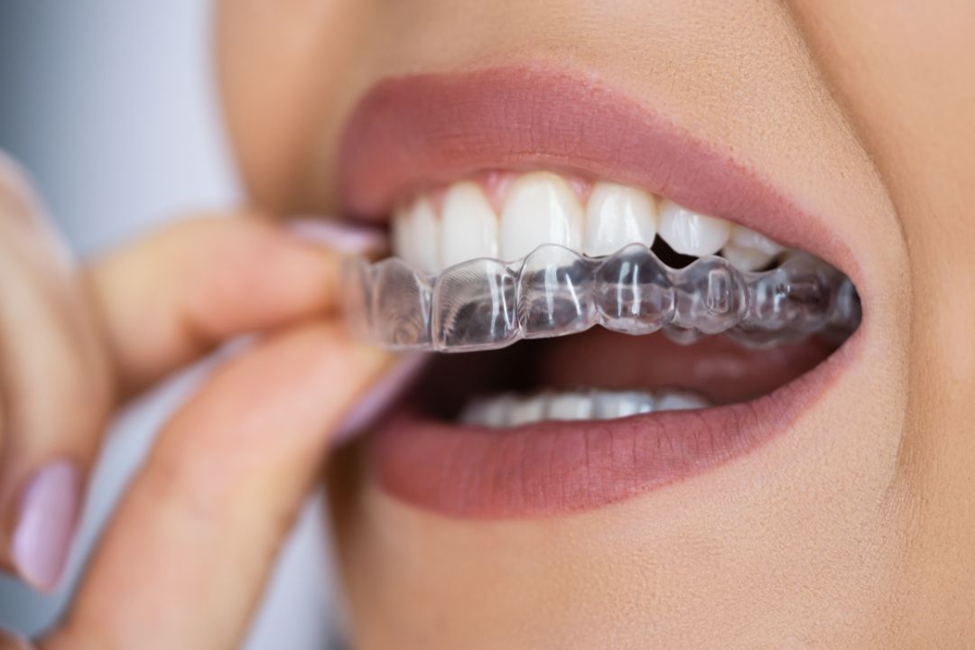 Orthodontic Treatment
