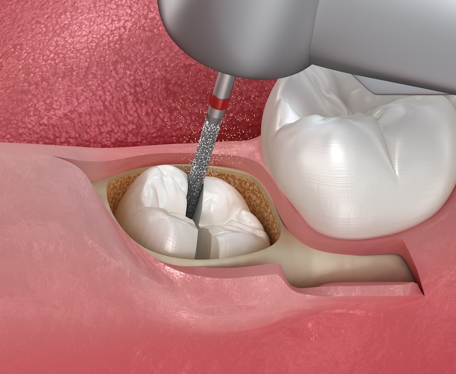 Tooth Extractions